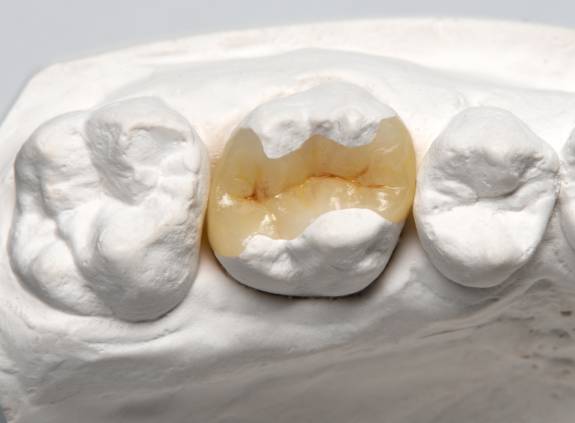 Gebissmodell mit Zahnersatz